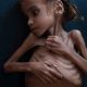 After War In Yemen 7 Year Old Girl Died Under Starvation